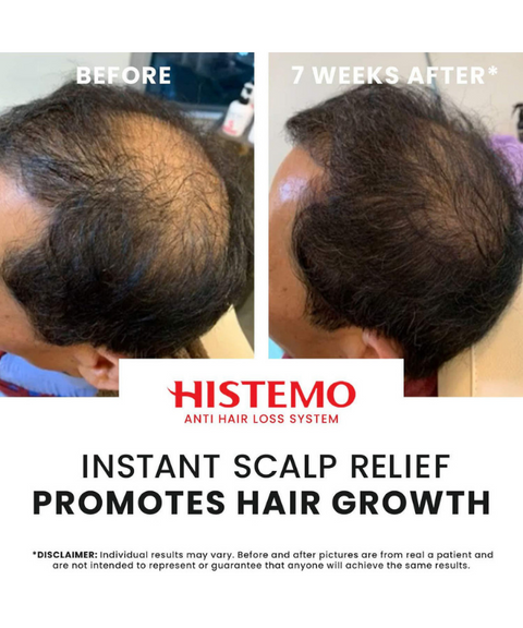 Histemo ION-TO T Forte Scalp Tonic